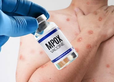 ¿Vacuna contra viruela del mono tendrá costo? México publica aviso de disponibilidad y cómo prevenir