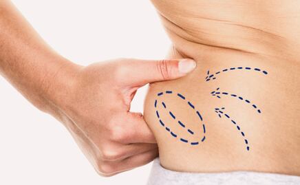 Guía completa: Esto cuesta una liposucción en México