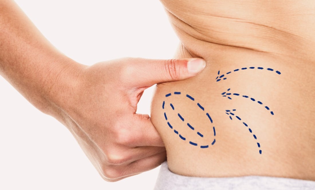 La liposucción es un procedimiento relativamente seguro, pero puede tener algunos riesgos, como sangrado, infección y daño a los nervios.( Foto: DeDinero)