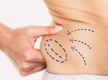 Guía completa: Esto cuesta una liposucción en México