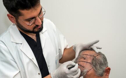 Costo de injerto de cabello en México 2024: Guía Completa de precios