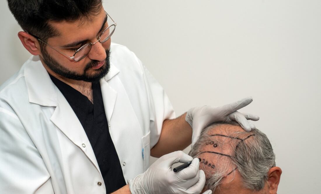 Te decimos todo lo que debes saber sobre los injertos capilares. (Foto: DeDinero)