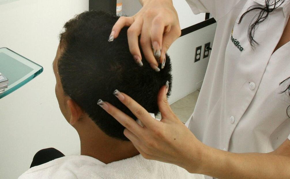 Los precios por un trasplante de cabello se ubican en decenas de miles de pesos, según lo publicado por médicos. (Foto: DeDinero)