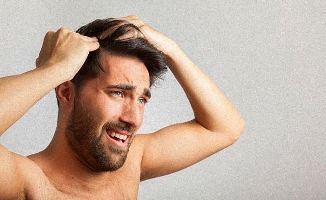 Para el trasplante, es necesario contar con un cuero cabelludo abundante en zonas como los lados y detrás de la cabeza. (Foto: DeDinero)